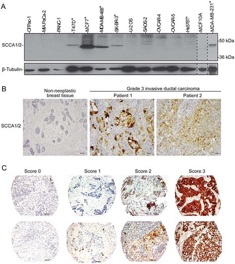 Elevated Scca Expression Is Found In Human Breast Cancer Cell Lines And