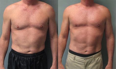 Gynecomastia Vs Chest Fat What You Need To Know We Want Science