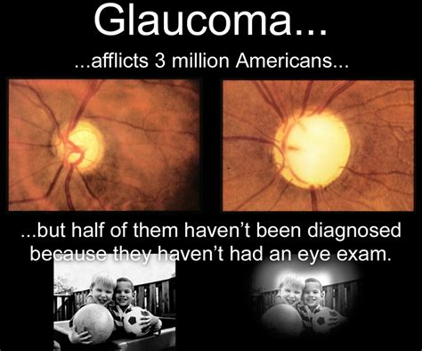 Glaucoma Diagnoses And Treatment By Dr Fouad Melamed