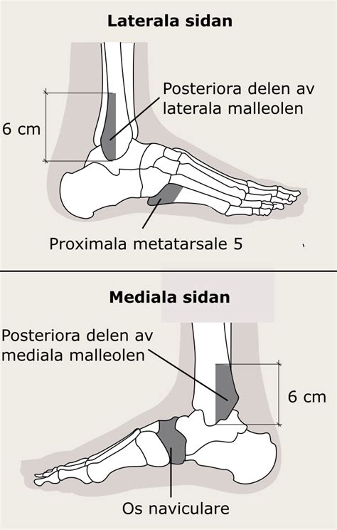Ligamentskada Lateral Fotled Ortobas