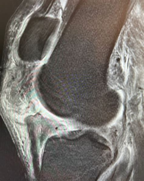 patellar tendon tear treatment  san jose dr pamela mehta