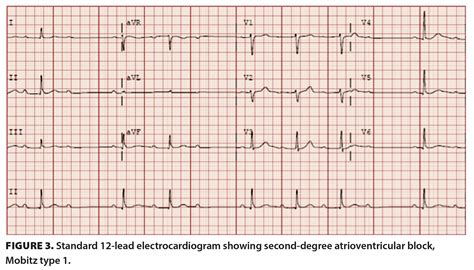 Third-degree heart block secondary to Lyme carditis | British Columbia ...