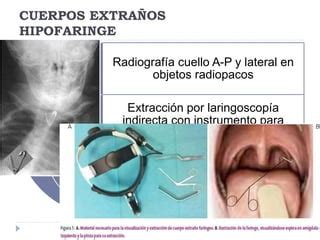 Emergencias Otorrinolaringol Gicas Ppt