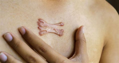 Facts About Keloid Scars