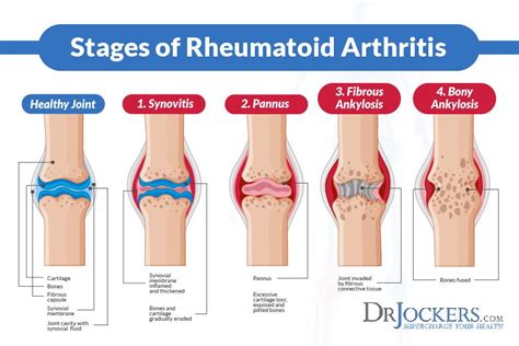 8 signs and symptoms of rheumatoid arthritis – Artofit