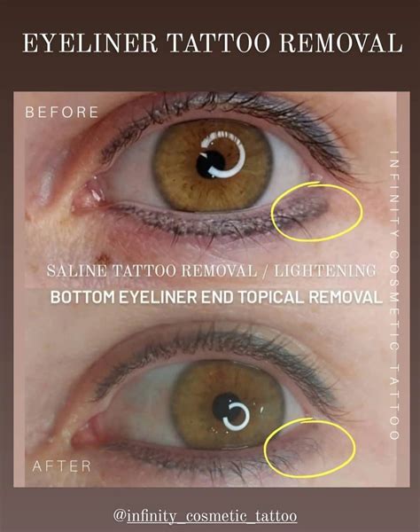 Eyeliner Tattoo Saline Removal And Lightening In Gold Coast