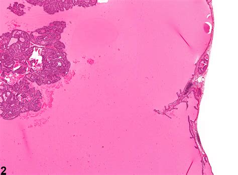 Coagulating Gland Hyperplasia Nonneoplastic Lesion Atlas