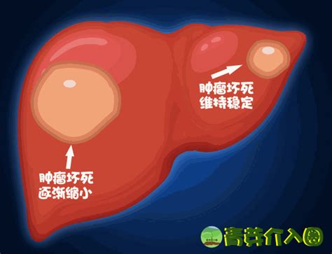 10張動圖揭秘肝癌介入治療tace全過程 每日頭條