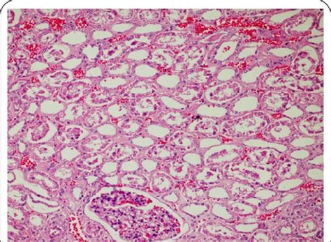 kidney case  marked congestion  peritubular capillaries
