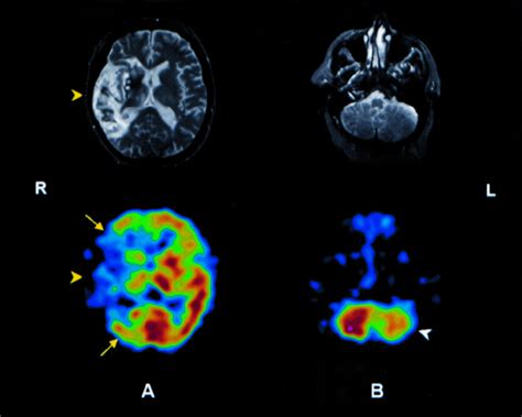 Brain Spect In Clinical Practice Part I Perfusion Journal Of Nuclear Medicine