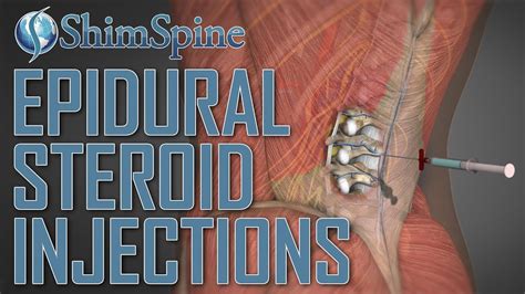 Epidural Steroid Injections Youtube