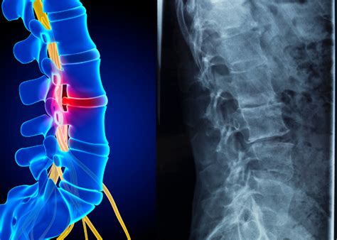 lumbar degenerative disc disease understanding   arthritis