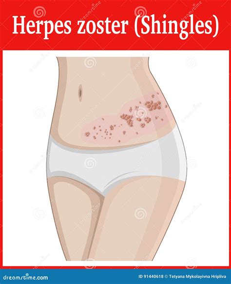 Illustration Of Herpes Zoster | CartoonDealer.com #91440618