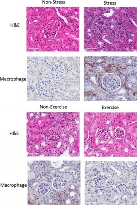 Fri0027 The Inflammatory Pathology Of Lupus Nephritis Is Significantly