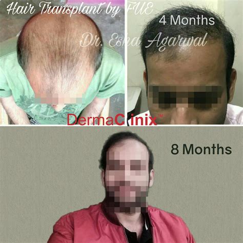 Hair Transplant Results Hair Transplant Before After Photos Ghaziabad