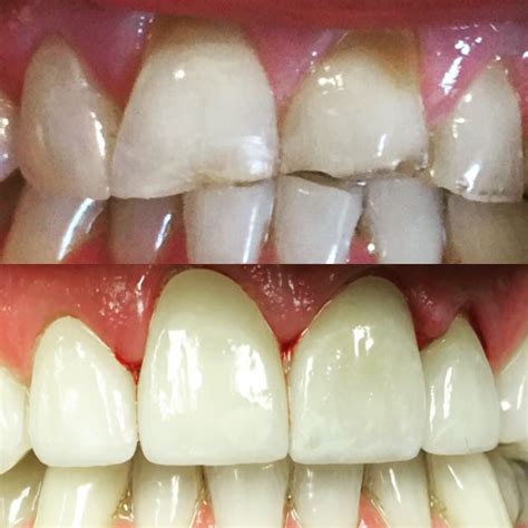 Veneers Infinity Dental Kernersville Nc Dentist