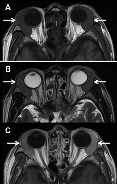 ocular adnexal igg related disease ct  mri findings british