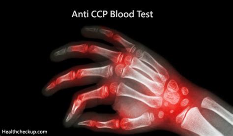 Anti-CCP Blood Test -Purpose, Procedure, Results and Normal Range by Dr ...