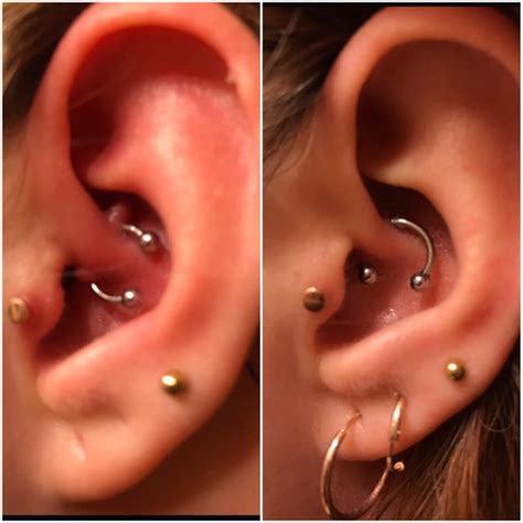 Daith Irritation Bump Healed R Piercing