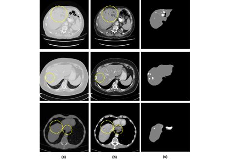 Samples Of Ct Images Containing Liver And Liver Tumors A Images From Download Scientific