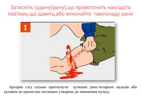 Презентація " Зупинка кровотечі"