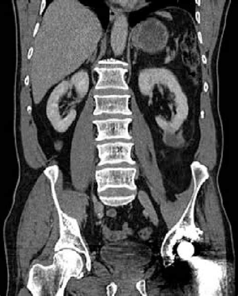 Figure 2 From A Benign Renal Cyst Containing Liesegang Rings Mimicking