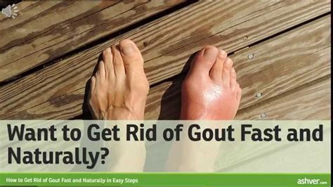 How To Get Rid Of Gout Fast And Naturally In Easy Steps Youtube