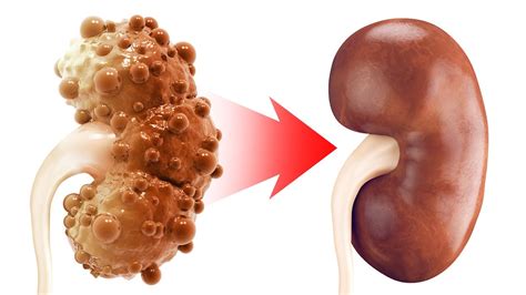 The Real Cause Of Chronic Kidney Disease And Polycystic Kidney Disease