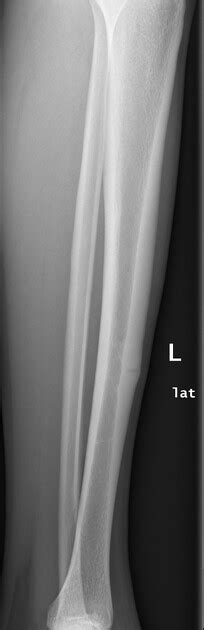 Stress Fracture X Ray Tibia