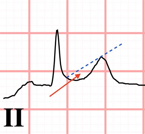 Teaching Medicine Tutorial Acs Plus