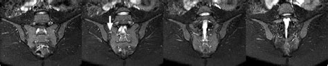 MRI findings of active and chronic sacroiliitis in light of recent ASAS ...