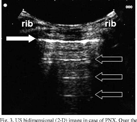 Figure From The Ultrasonographic Deep Sulcus Sign In Traumatic