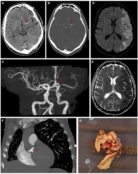 Frontiers Spontaneous Calcified Cerebral Emboli A Comprehensive