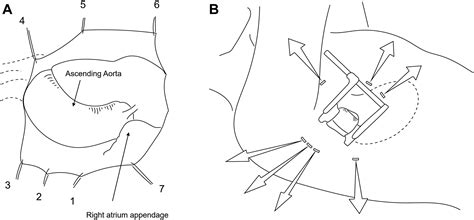 Y Incision And Roof Technique For Aortic Root Enlargement A Minimally