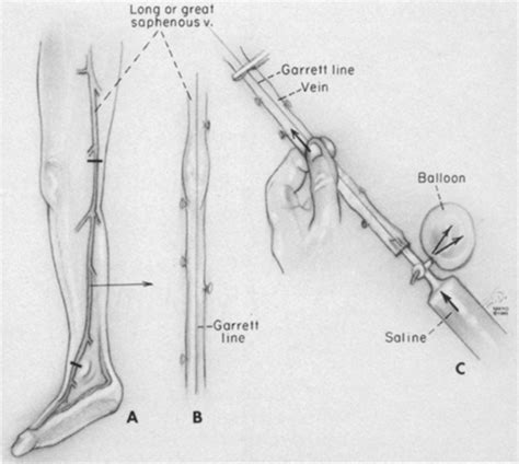 leg vein grafts