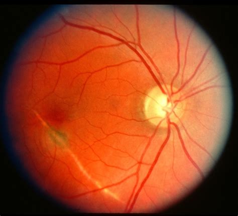 Choroidal Rupture With Cnv Colour Image Retina Image Bank