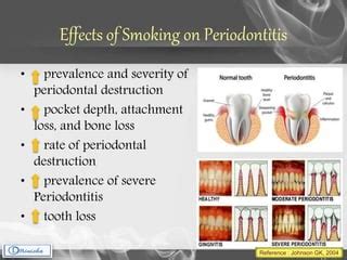 smoking  periodontium