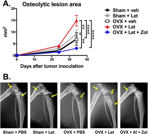 Osteolytic Bone Metastases Assessed By Radiography In Estrogen