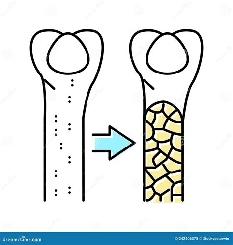 Osteoporosis Bone Image Cartoon Vector 106191383