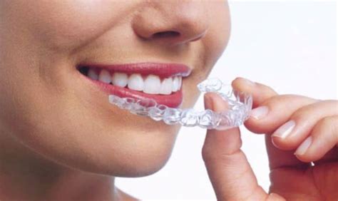 Reasons Why Invisalign Is The Best Way To Straighten Your Teeth