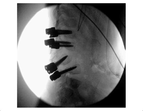 Intraoperative Fluoroscopic View Showing Anatomical Trajectory Of