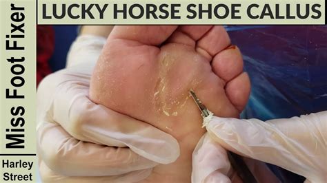 Lucky Callus How To Remove Callus Completely And Slowly By Miss Foot