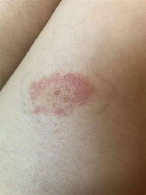 Doctor said it’s just a reaction to a harmless bug bite - should I get