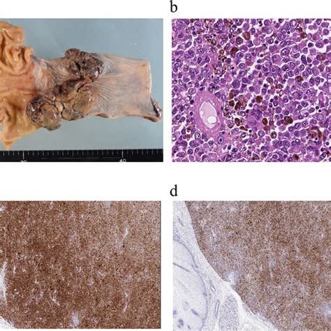 Macroscopic And Microscopic Findings Of The Resected Specimen A