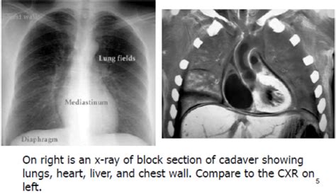 chest xray interpretation flashcards quizlet