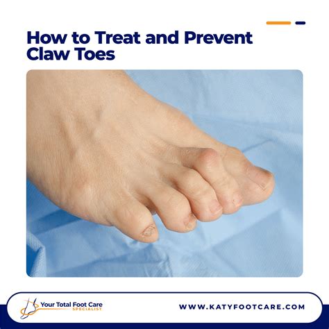 How to Treat and Prevent Claw Toes | Expert Advice | YTFCS