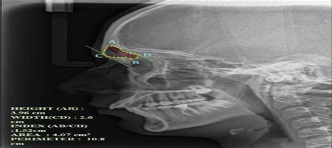 Efficacy Of Frontal Sinus As A Reliable Tool For Sex Differe Indian Journal Of Dental Research