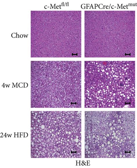 More Pronounced Disease Progression Of Diet Induced Steatohepatitis In