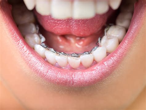 Teeth Wiring Cost In India