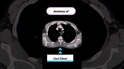 Anatomy of CECT Chest #anatomy #anatomyscan #anisqureshi #doctor - YouTube